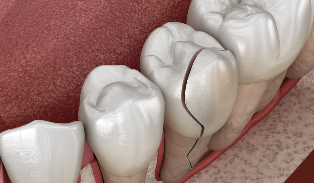 How Serious is a Cracked Tooth? Dental Emergency 101
