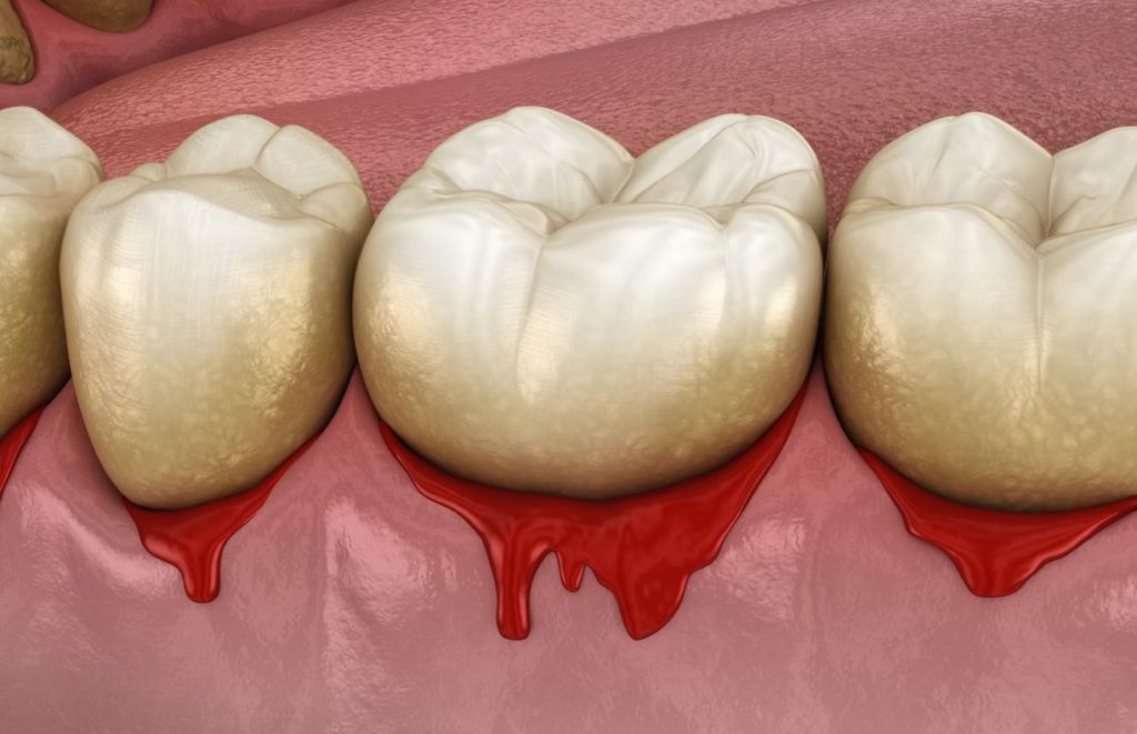 gum disease and symptoms