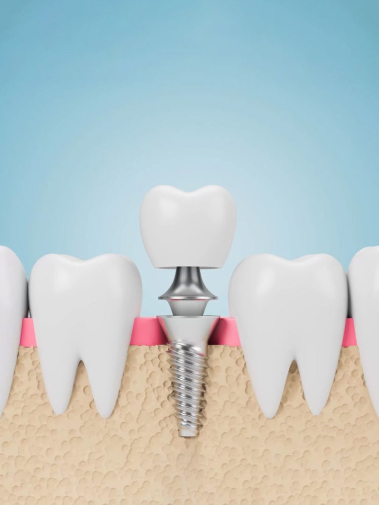 How Much Does a Dental Implant Cost for One Tooth?