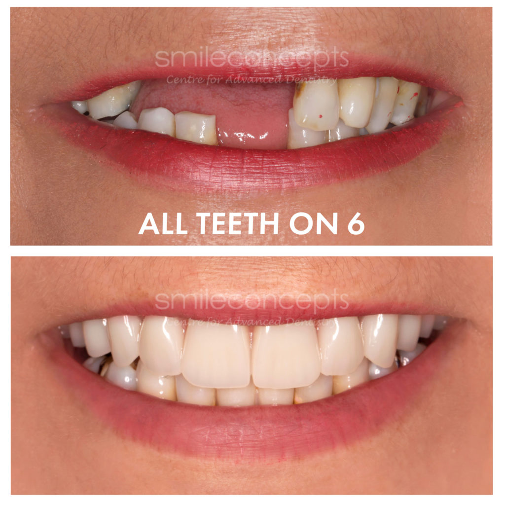 all teeth on 4 or 6 before and after model