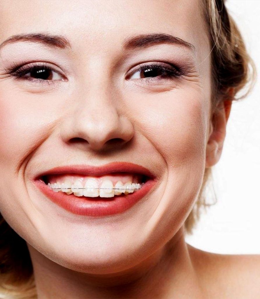 orthodontics options with ceramic braces