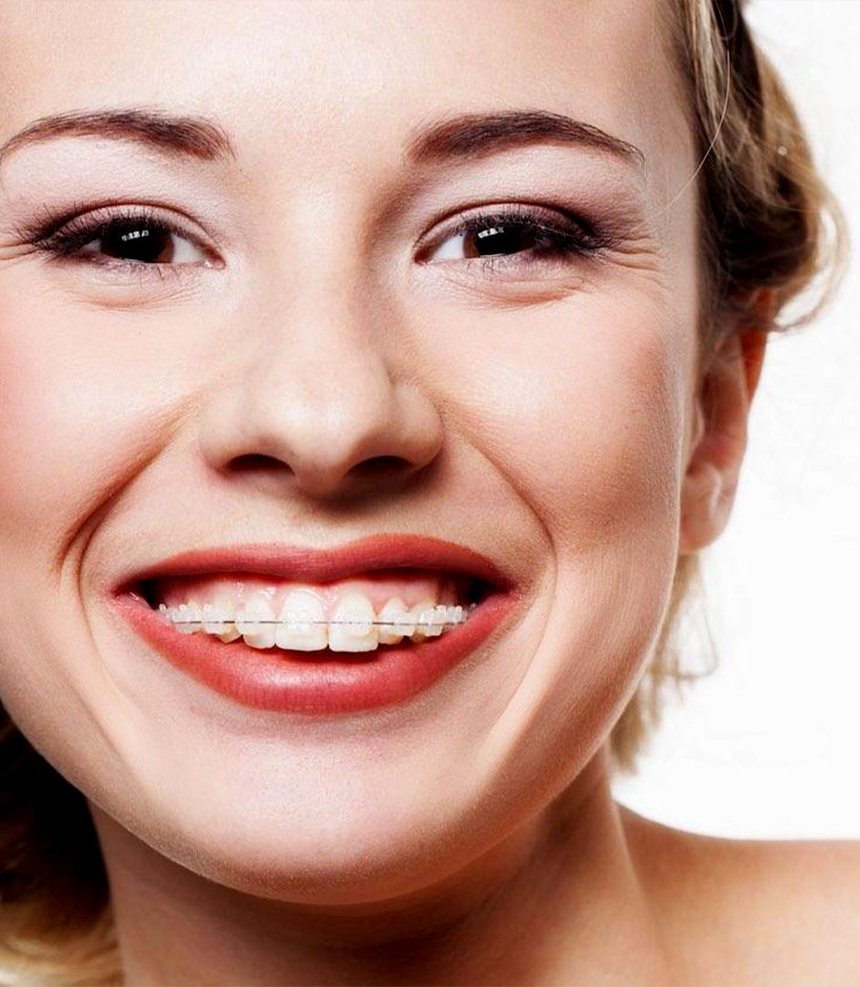 Красивые девушки с брекетами