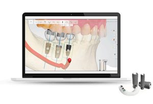 digital-dental-implant