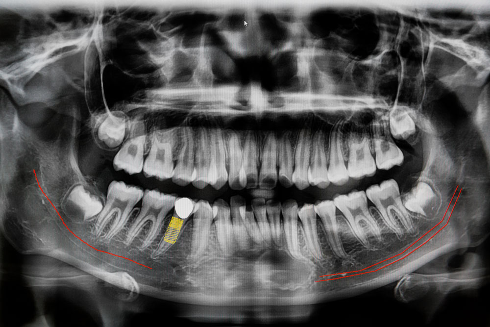 How Long Does A Dental Implant Procedure Take?