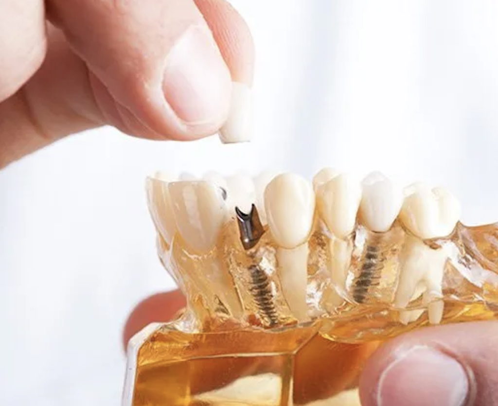 How Long Does A Dental Implant Procedure Take?