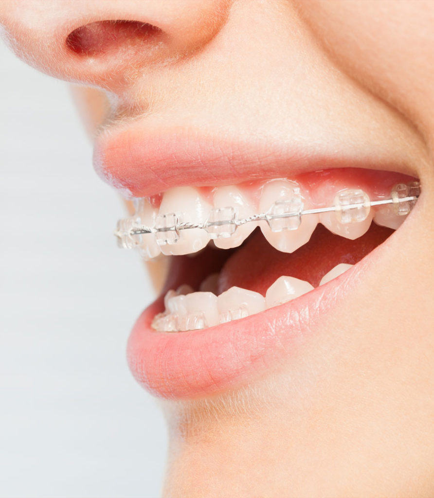 orthodontics options with clear braces