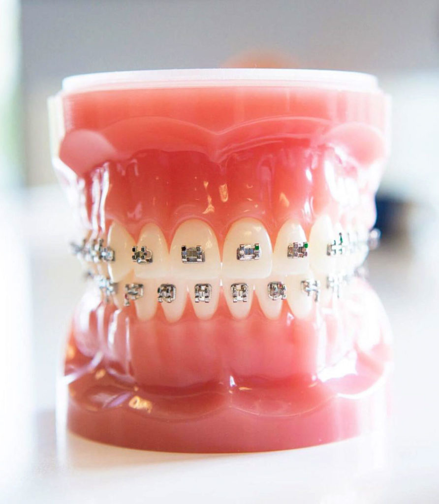 orthodontics options with damon braces