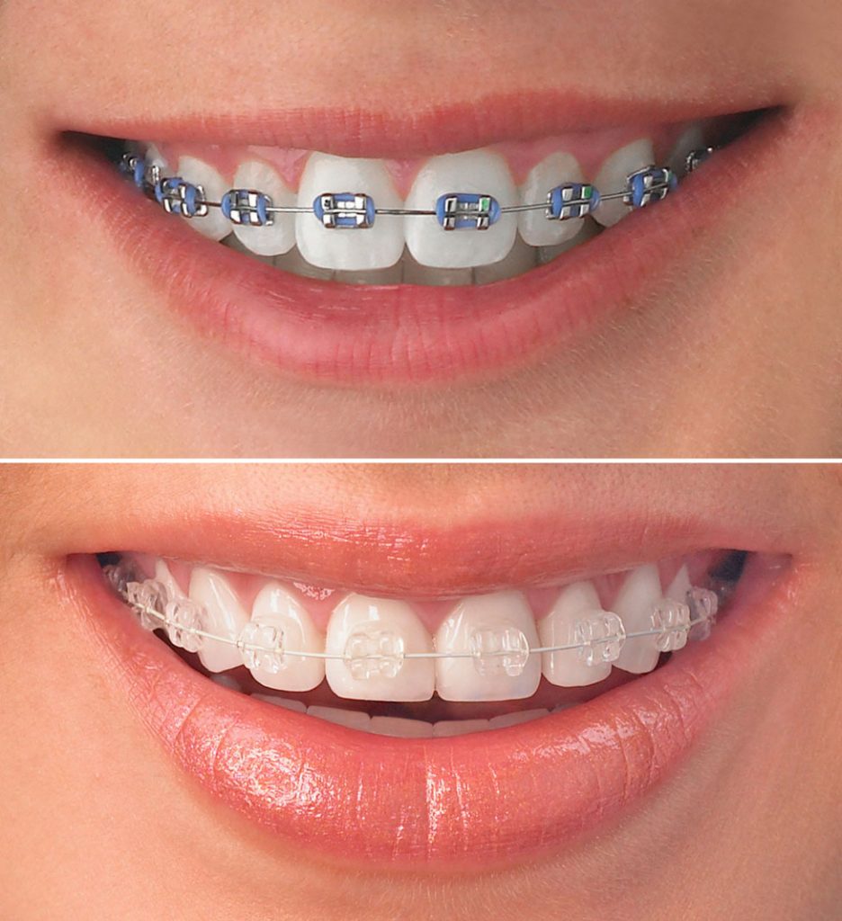 Ceramic Braces Vs. Traditional Metal Braces