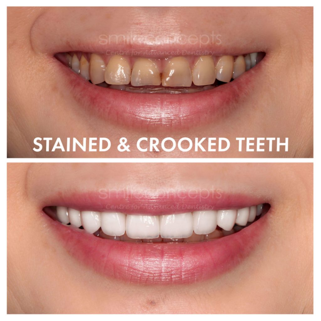 example of veneers to treat teeth straightening