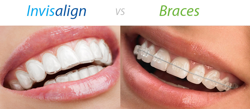 How Long Does Invisalign Take To Straighten Your Teeth?