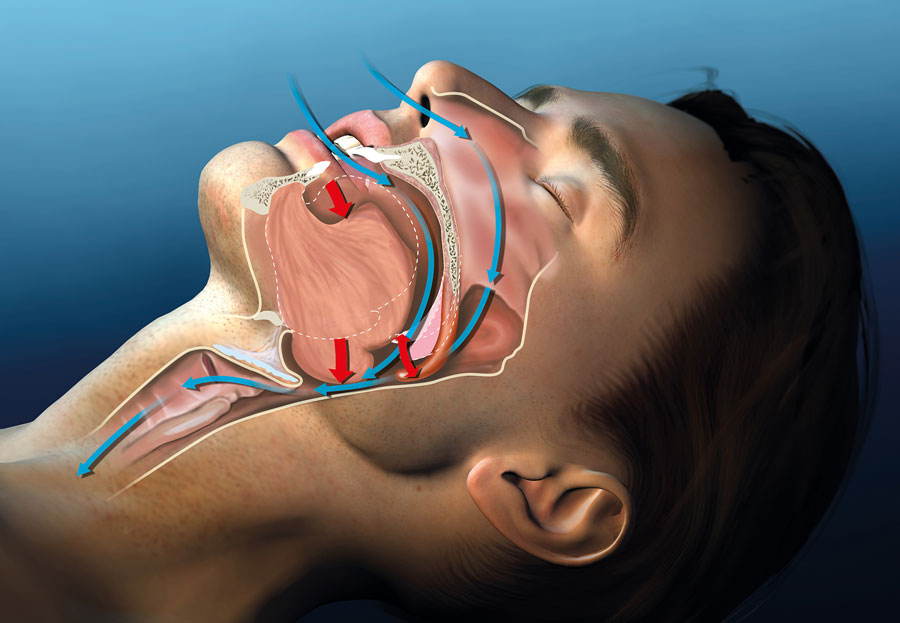 Best Anti-Snoring Mouthpieces and Mouthguards of 2022