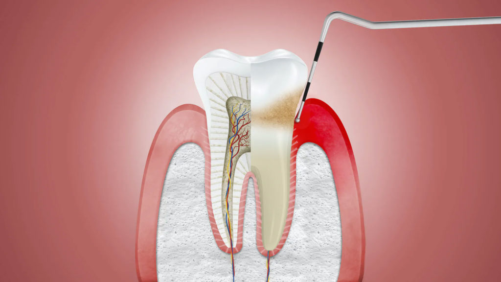 How Do You Get Rid Of Swelling Gums? Causes, Treatments And Home Remedies