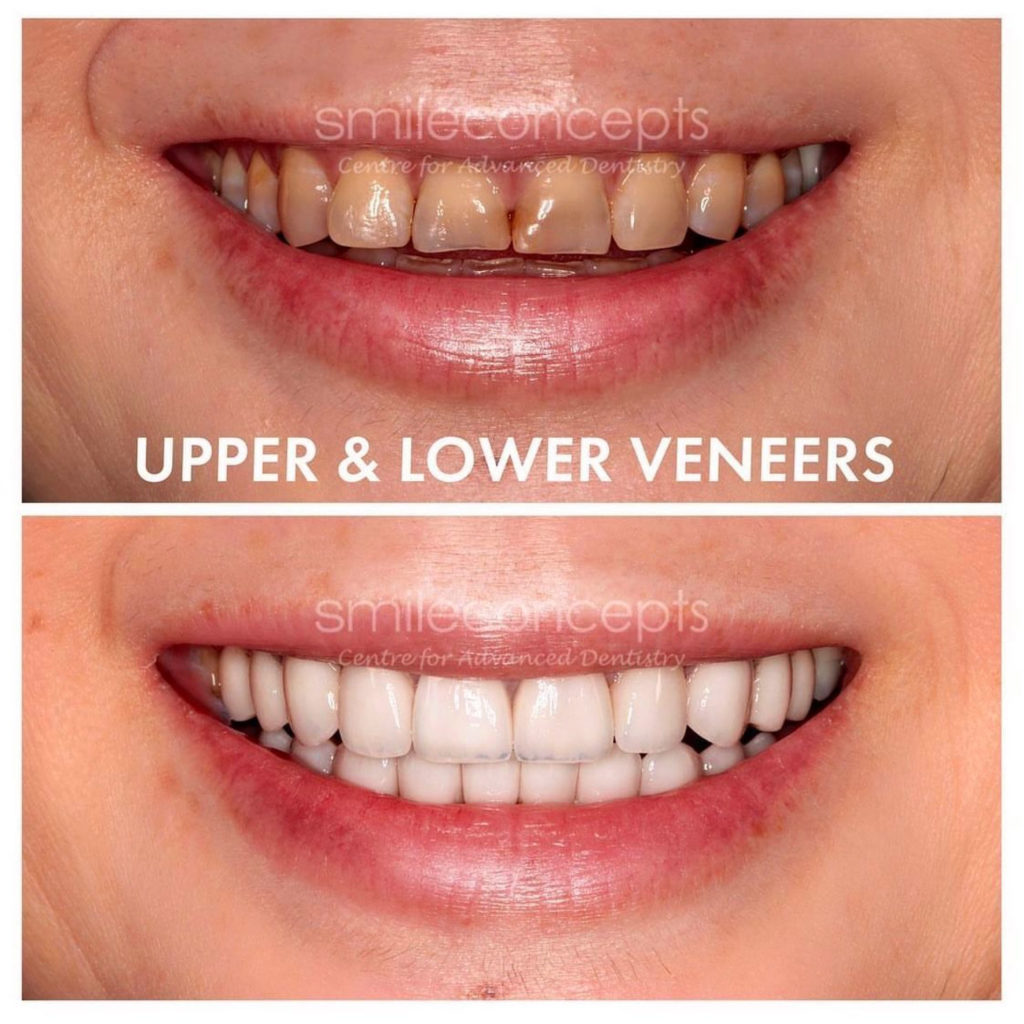 How Long Do Veneers Last On Teeth? All You Need to Know About Veneers