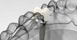 concept-of-dental-care dental implant