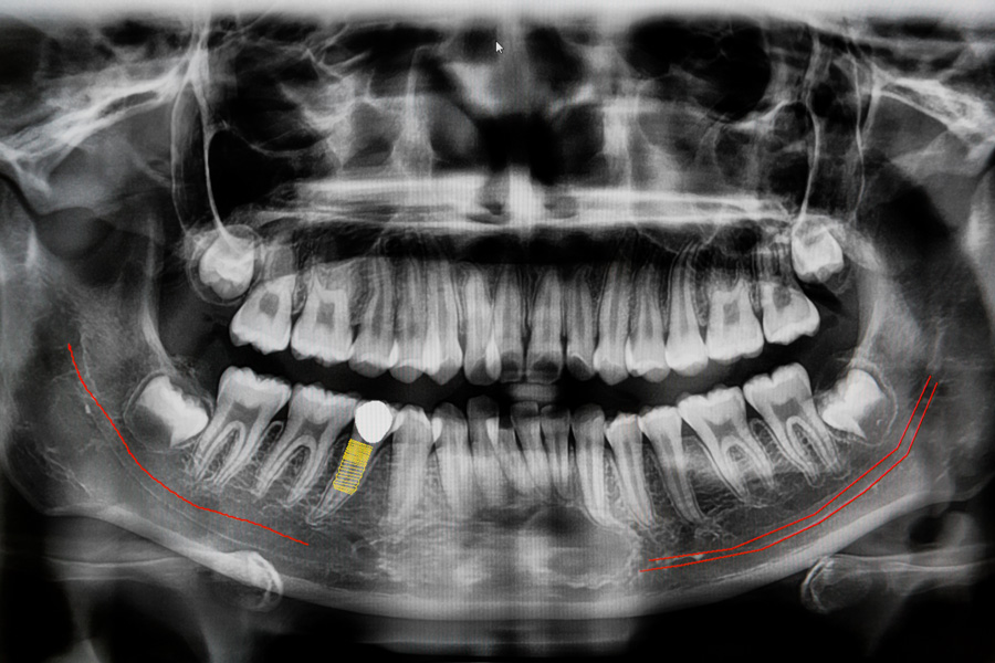 Does Medicare Cover Dental Implants in Australia?