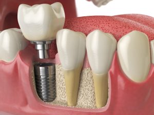 does-medicare-cover-dental-implants