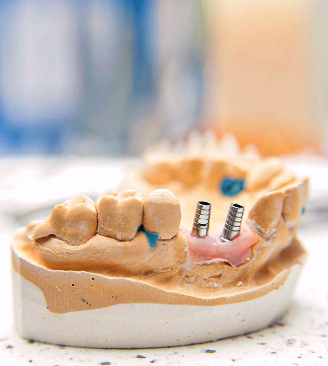 dental-implants-sydney-on-a-mould