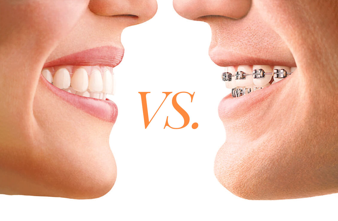 Is Invisalign Cheaper Than Braces? Your Updated Guide (2023)