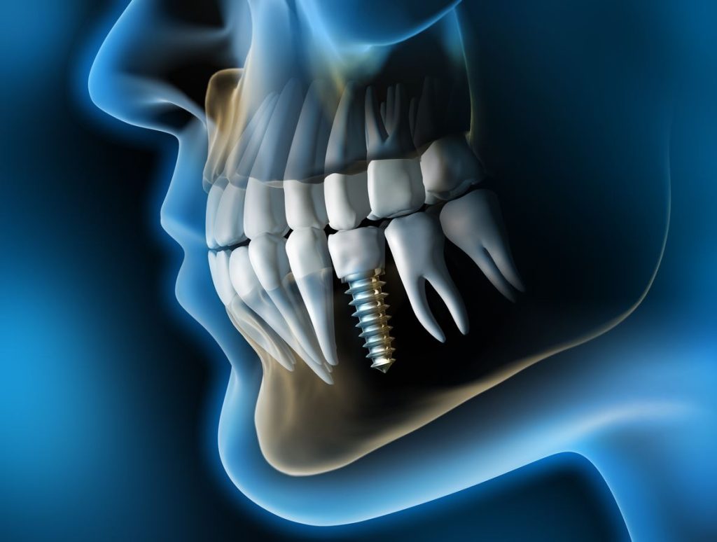 dental implants on a scan