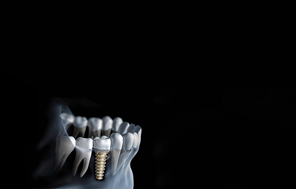 Dental implants procedure overview at Smile Concepts, Sydney. We are experts in placing high-quality denture implants for missing teeth. We provide the affordable dental implants in Sydney without compromising on material standards. Our transparent pricing ensures you understand the cost of dental implants in Sydney upfront. Trust Smile Concepts for affordable dental implants and reliable tooth replacement. Book your consultation with our skilled team today.