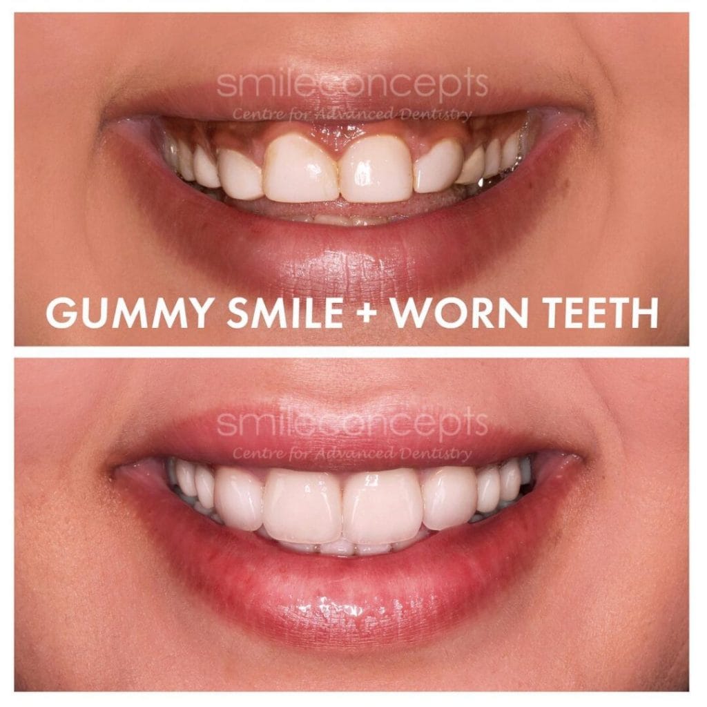Smile Comparison