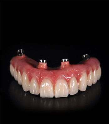 Graphic explaining the All-on-4 dental implant technique at Smile Concepts, Sydney. We educate patients on the benefits of fixed teeth over removable denture implants. We are committed to offering the cheapest dental implants in Sydney without compromising on information or quality. With transparent pricing, we ensure you understand the cost of dental implants in Sydney. Trust Smile Concepts for affordable dental implants and clear, honest advice. Book your consultation today.
