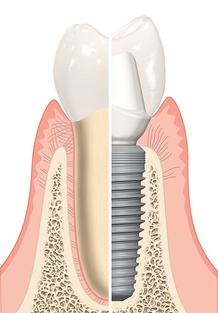 Dental implant example model at Smile Concepts, Sydney. Visualizing the structure of our high-quality denture implants. We are committed to offering the cheapest dental implants in Sydney without compromising on the implant quality. With transparent pricing, we ensure you understand the cost of dental implants in Sydney. Trust Smile Concepts for affordable dental implants and clear demonstrations. Book your consultation to learn more today.