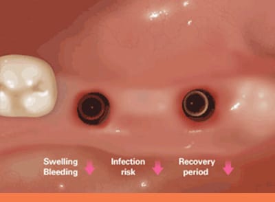 Replace missing teeth with dental implants in Sydney that cost from 0/week. Our dental implant experts have over 30 years of experience.