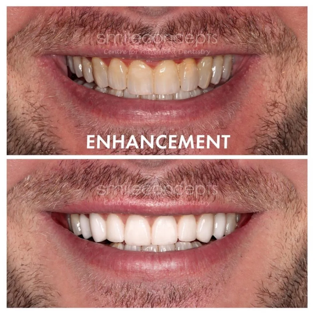 Smile Comparison