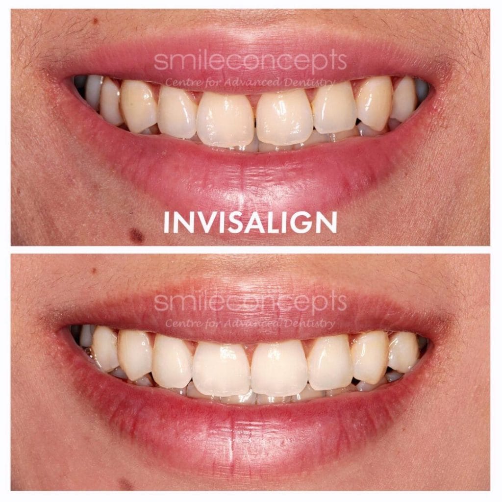 Smile Comparison