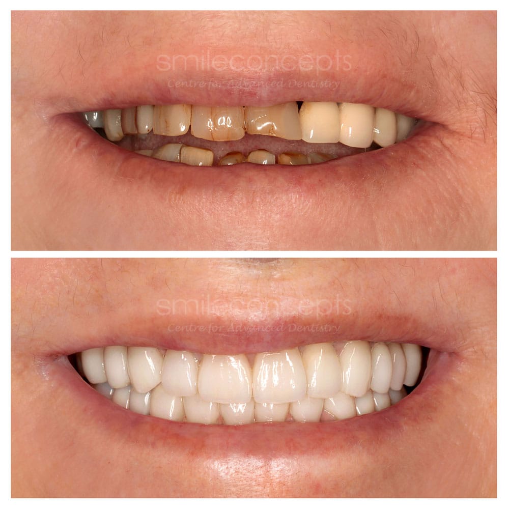 Dental implant scenario image inviting you to consider if implants are right for you at Smile Concepts, Sydney. As a leading clinic, we provide perfect candidates with top-tier denture implants. We are committed to making this transformative treatmentaccessibleto everyone. With our transparent andaffordablepricing, you can confidently invest in a permanent solution for missing teeth. Contact our expert team today to book your consultation.