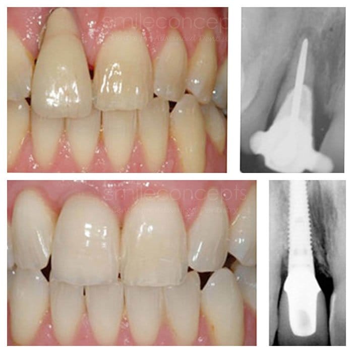 The process of dental implants treatment is very simple. Just get an appointment with our dentists and your dental implants will be installed without any fuss.