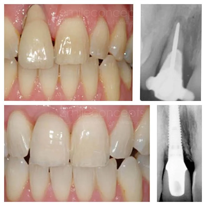 An initial consultation image at Smile Concepts, Sydney, where your journey begins. We listen to your concerns, desires, and medical history before starting any treatment. Our team builds a relationship of trust and open communication with every patient. We ensure you feel heard and understood. Start your dental journey with a professional consultation where we discuss all your options and create a path toward achieving optimal oral health and a beautiful smile.