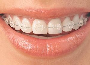 Crooked-braces