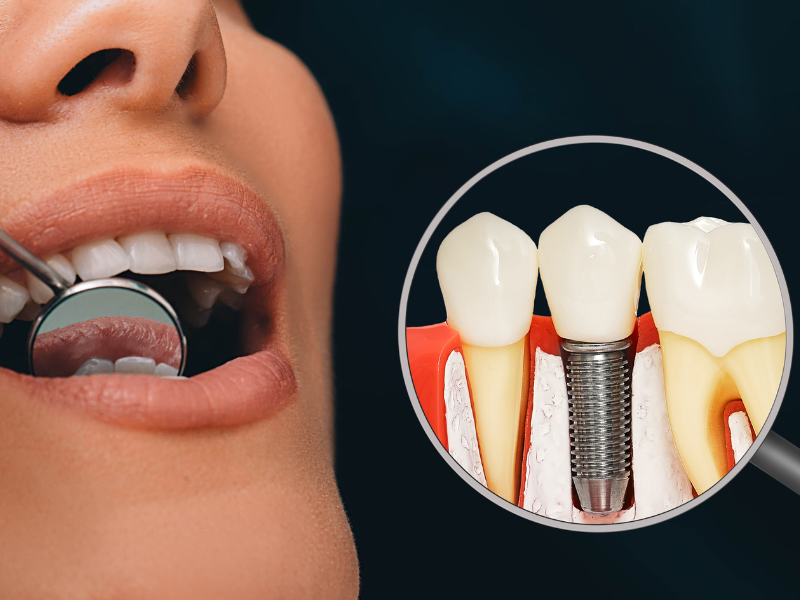 Why Dental Implants Are a Worthy Investment