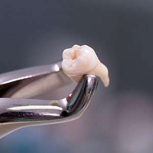 wisdom_teeth