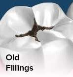 old_fillings