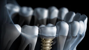 This image represents the concept of All on Four Sydney dental implant treatment, a reliable solution offered at Smile Concepts for patients needing full-arch restoration. Our clinic focuses on long-lasting, natural-looking outcomes supported by transparent pricing and personalised planning. This visual highlights the transformative potential of All on Four treatment for individuals with failing teeth or significant tooth loss. Sydney patients seeking affordability, function, and improved confidence can trust our experienced team for tailored implant-based rehabilitation.