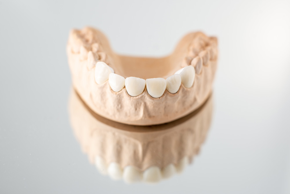 veneers