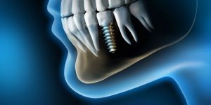 digital-image-of-teeth-and-jaw-with-dental-implant-screw