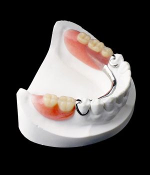 denture implants